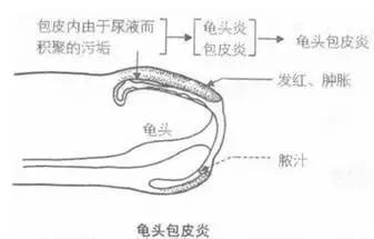 龟头炎的症状是什么?龟头炎的危害是什么?龟头炎怎么治疗?