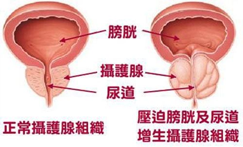 前列腺囊肿的危害?前列腺囊肿的症状?前列腺囊肿怎么预防治疗?