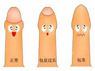 「贴士」包皮过长都要割吗？多大可以割？